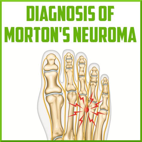 morton's neuroma compression test|morton's neuroma prognosis.